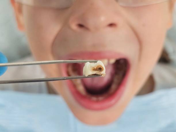Best Dentist for Tooth Abscess  in Morrice, MI